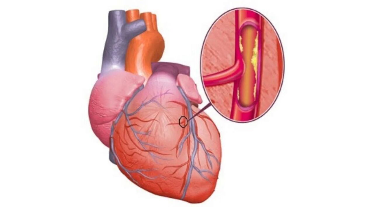 Problèmes cardiaques dus à l'hypertension artérielle